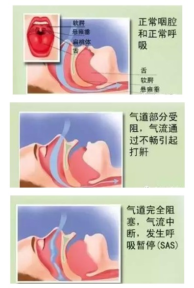 呼吸機(jī)可以完全治愈睡眠呼吸暫停嗎？